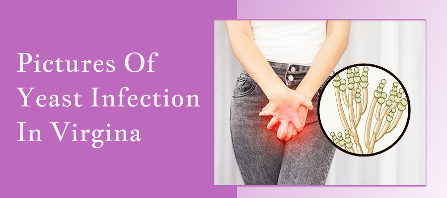 Pictures Of Yeast Infection In Virgina